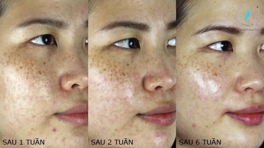 Kết quả sau khi sử dụng Skinceuticals Discoloration Defense